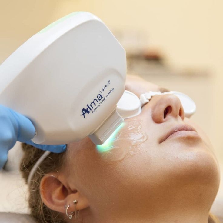 Alma Q Laser Treatment