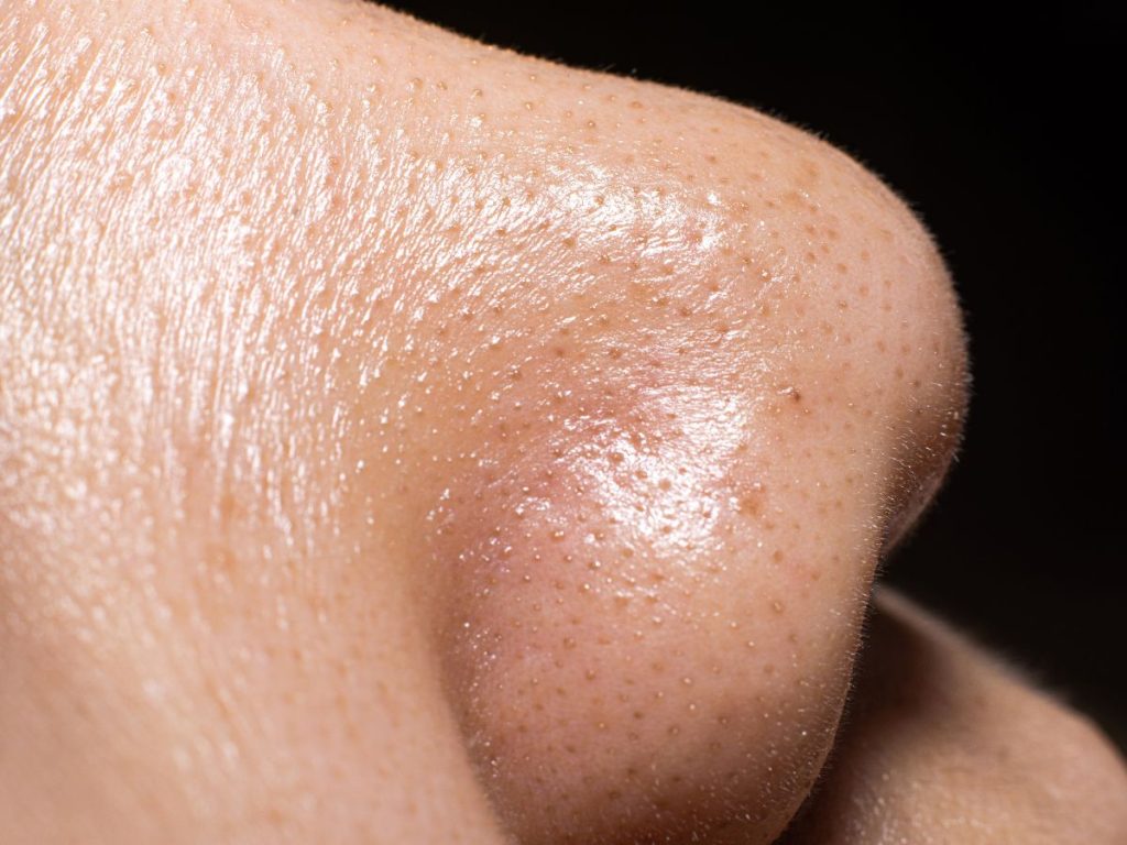 Blackheads