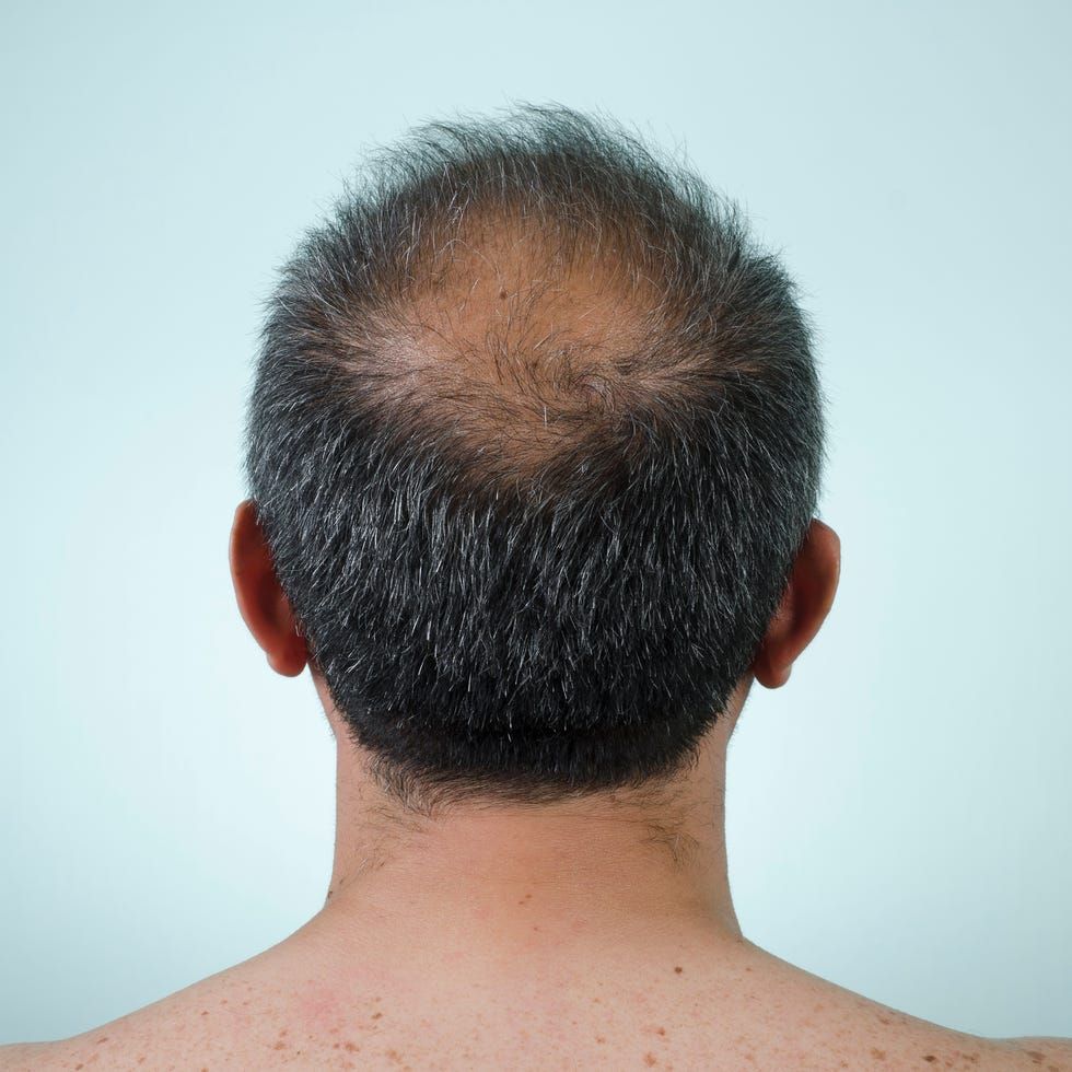 Understanding the Causes and Solutions for Hair Loss